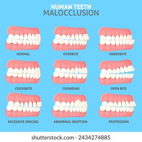 Malokklusionstypen mit Seitenansicht der Normalen, Fehlausrichtung und falscher Beziehung zwischen menschlichen Zähnen von Ober- und Unterkiefer Vektor-Illustration