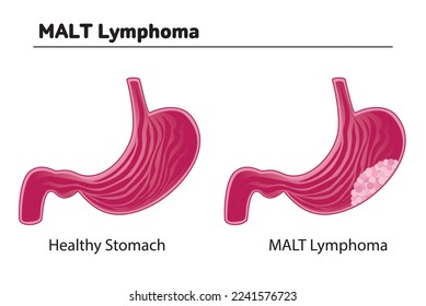 MALT-Lymphom mit rosafarbenem Magen und weißem Hintergrund. Es zeigt gesunden Magen und Lymphom. Vektorgrafik.