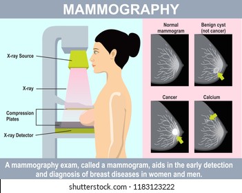 Mammography infographics. Woman get mammograms for breast cancer screening. Illustration about protection breast cancer with medical technology. Using low energy X-rays to examine the woman breast.