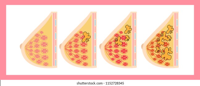 Mammography is the process of using low energy x-rays to examine the woman breast for diagnosis and screening. medical cartoon vector  illustration.