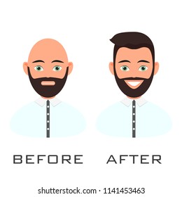 Man with alopecia problem before and after hair treatment and transplantation. Male baldness set in cartoon style. Perfect for clinics and diagnostic centers.