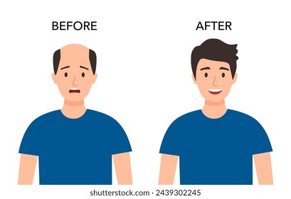 Man with alopecia problem before and after hair treatment and transplantation. Male baldness set in flat style.