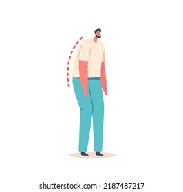 Man with Bent Spine and Head Tilt. Male Character Wrong Standing Position, Bad Back Posture. Spinal Health Curvature, Scoliosis Disease Isolated on White Background. Cartoon People Vector Illustration