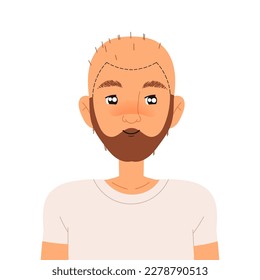 Personnage homme faisant des transplantations de cheveux Souffrant d'Alopécie ou de calvitie Illustration vectorielle