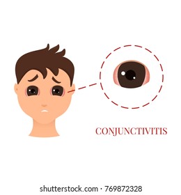 Man with conjunctivitis. Closeup view. Sad patient with pinkeye. Infectious viral disease. Medical concept. Anatomy of people. Vector illustration.