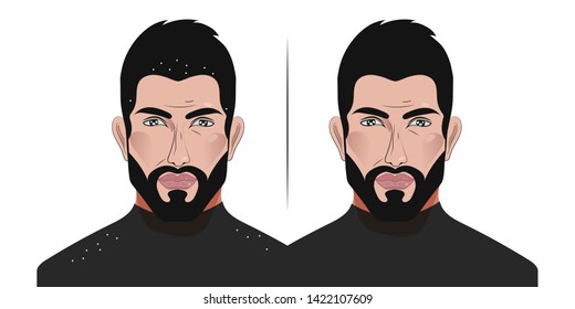 Man with dandruff falling on his shoulders, before and after therapeutic anti-dandruff shampoo, personal hygiene and attractiveness, health care, seborrhea. Vector illustration