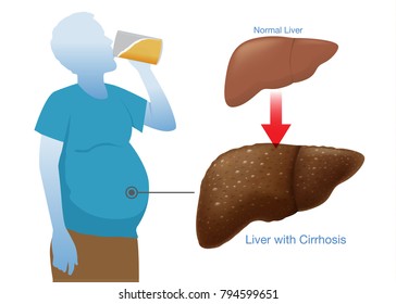 Man trinkt Alkohol hat einen übergroßen Bauch und seine Leber zu entzünden und geschwollen.
Illustration über die körperliche Verfassung von Menschen, die Symptome einer Zirrhose haben.