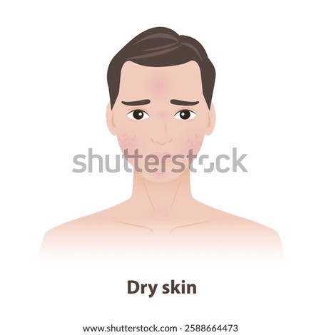 The man with dry skin on face illustration. Caused by heat, sunshine, stress and environmental variables, lead to dryness, dehydration, itching, irritation and cracking of skin. Men skin care concept.