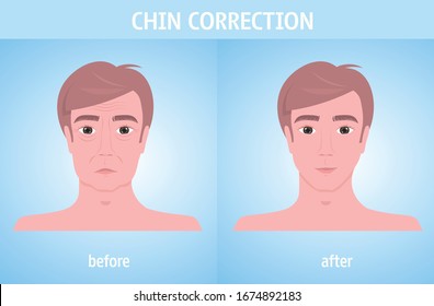 man face before and after chin correction facial lift reduction treatment skincare removing wrinkles aesthetic medicine concept horizontal portrait vector illustration