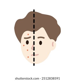 Man face head with red rash pimple skin problem comparison. Beauty, skincare, treatment, hygiene, allergy concepts. Flat vector character design isolated illustration.