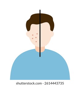 Man face with red rash pimple skin problem. Before and after comparison. Beauty, skincare, treatment, hygiene, allergy concepts. Flat vector character design isolated illustration.