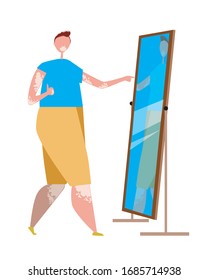 A man or a guy with vitiligo is satisfied with his appearance and skin pigmentation. Flat vector stock illustration with a mirror and a dermatological problem as a concept of a positive body