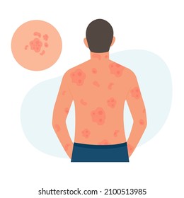 The man has alergic itching, skin inflammation, redness and irritation.Guttate psoriasis.Atopic dermatitis, eczema, psoriasis, dry skin. Skin problems.isolated, vector.