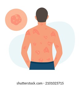 The Man Has Alergic Itching, Skin Inflammation, Redness And Irritation. Pustular Psoriasis.Atopic Dermatitis, Eczema, Psoriasis, Dry Skin. Skin Problems Concept, Isolated, Vector.