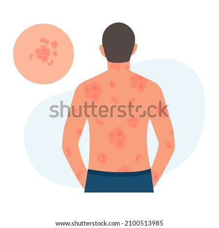 The man has alergic itching, skin inflammation, redness and irritation.Guttate psoriasis.Atopic dermatitis, eczema, psoriasis, dry skin. Skin problems.isolated, vector.