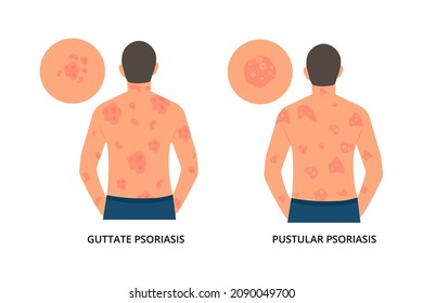 Man has allergic itching, skin inflammation, redness and irritation.Guttate,postular psoriasis.Atopic dermatitis, eczema, psoriasis, dry skin. Skin problems.isolated, vector.