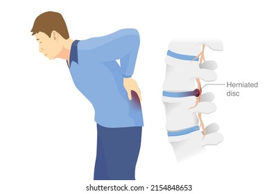 Man has low back pain and sciatica from a herniated disc. Medical diagrams about trapped nerves make patients chronic pain in the back and paralysis.