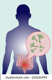 Man have fungus In the intestine.