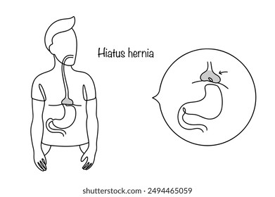 A man with a hiatal hernia. A disease in which the upper part of the stomach enters the chest through the opening of the diaphragm. Vector illustration.