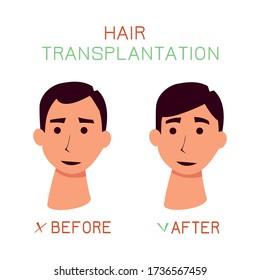 A man on a white background before and after a hair transplant. Flat vector illustration.