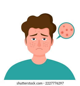 Man with pimple on face in flat design. Guy acne skin problem.