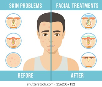 Man with a problem skin. Treatment of acne, skin care, men's cosmetics. Vector