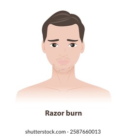 The man with razor burn on face and neck vector illustration. Razor bumps or Pseudofolliculitis barbae caused by shaving, lead to redness, irritation, ingrown hairs. Men skin care concept.