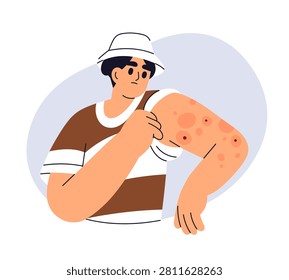 Man with red marks, rash on arm, checking itchy skin. Allergic reaction on bites, dermatology problem. Allergy, redness, inflammation and itch. Flat vector illustration isolated on white background.