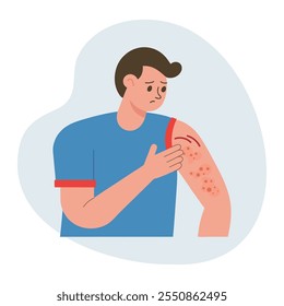 Hombre rascándose la mano. Picazón alérgica, inflamación de la piel, enrojecimiento e irritación. Dermatitis atópica, eccema, psoriasis. Salud y medicina.