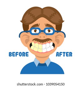 Man show mouth with great teeth before and after care cleaning treatment and whitening. Healthy smile Vector modern flat style cartoon character illustration isolated white background dentist concept.