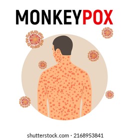 Man sick with monkey smallpox in flat style isolated on white background. Background with monkey pox virus. Vector illustration.