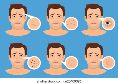 Man Skin Problems Vector Illustration. Male Face With Pimples And Dark Spots, Wrinkles And Acne