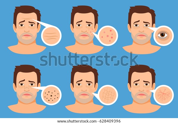 男性の皮膚の問題のベクターイラスト にきびと黒い斑点 しわ にきびを持つ男性の顔 のベクター画像素材 ロイヤリティフリー 628409396
