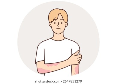 Man suffering from dermatitis and skin diseases with spots on hands needs help of dermatologist. Sad guy is sick with dermatitis or measles and chickenpox due to non-compliance with hygiene rules