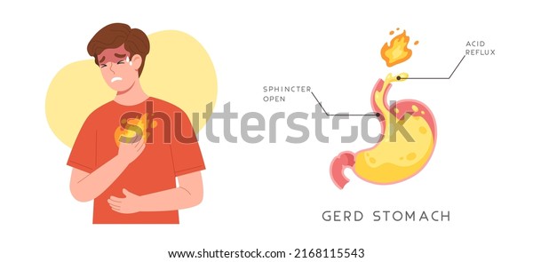 Man\
suffering from GERD symptom with acid reflux because of sphincter\
opened stomach. \
Gastroesophageal reflux disease. Heartburn.\
Digestive system disease. Flat vector\
illustration.