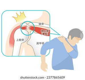 Man suffering from shoulder rotator cuff tear pain :Translate.scapula, supraspinatus muscle ,Rotator cuff tear