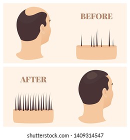 Woman Thinning Hair Before After Hair Stock Vector (Royalty Free ...