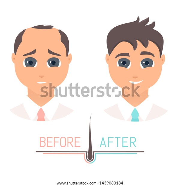 Man Thinning Hair Before After Hair Stock Vector Royalty Free