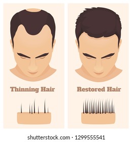 Man with thinning and restored hair. Male pattern alopecia set with skin cross-section diagram. Before and after concept. Vector illustration. 