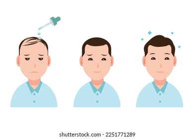 The man treat hair loss vector isolated on white background. Before and after increase density, loss, fall, lacking hair, alopecia and baldness rescue with treatment. Hair care concept illustration.
