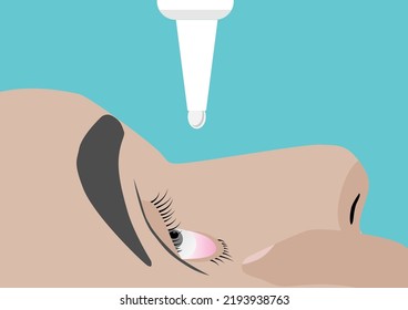 Man using finger opening eyelid and applying eyedropper. Vector illustration.