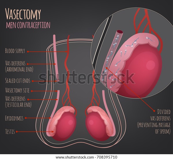 Man Vasectomy Image Contraception Concept Male Stock Vector (Royalty