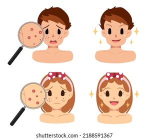 Man and woman with acne. Compare the development of the beauty face. Acne becomes a beautiful face without acne.