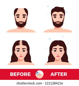 Man And Woman Before And After Hair Transplantation On White Background Flat Vector Illustration