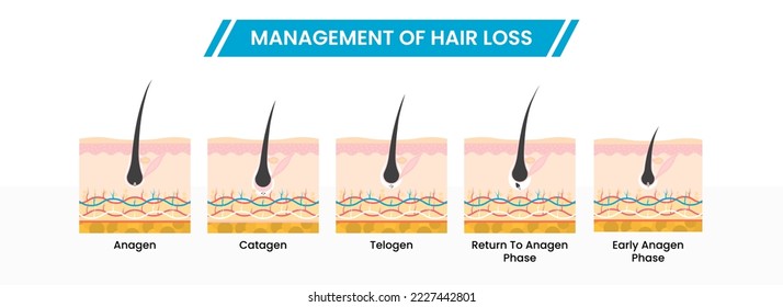 Management Of Hair Loss Or Growth Phases Infographic Scheme Icons In Flat Style.