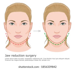 Mandibuloplasty surgery before and after illustration. V-line surgery. 