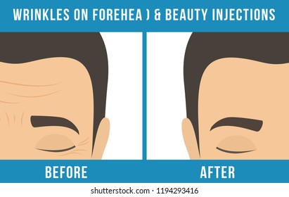 Man's anti-aging skin care and men's cosmetics. Different types of facial wrinkles. Man before and after beauty injection. Anti-aging procedure. Vector