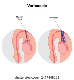 Man's problem Varicocele and normal vein