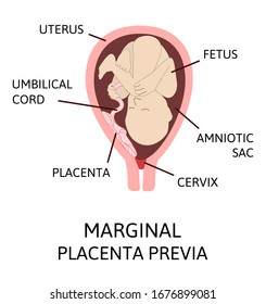Marginal Placenta Location During Pregnancy. Major placenta previa. detailed medical picture with table of symbols. Pathology. Colored vector illustration isolated on white background