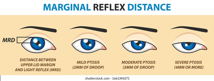 Marginal reflex distance. Vector illustration.